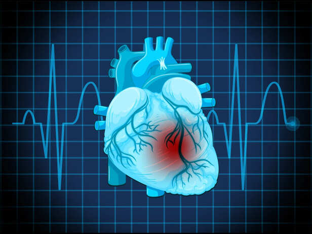 The New Heart Attack Classification Explained