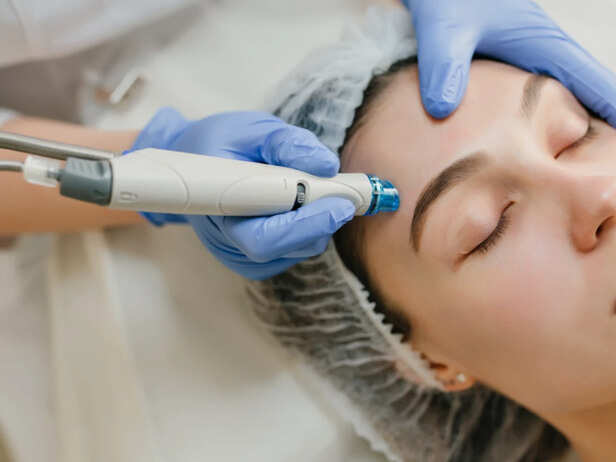 Microneedling Smooths Texture Over Time