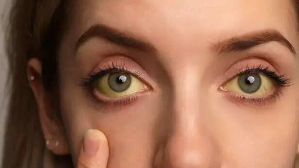 Jaundice: Causes, Symptoms, and Treatment Options