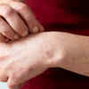 Recurring skin rash