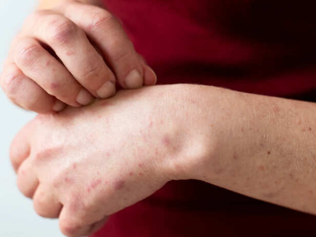 Recurring skin rash