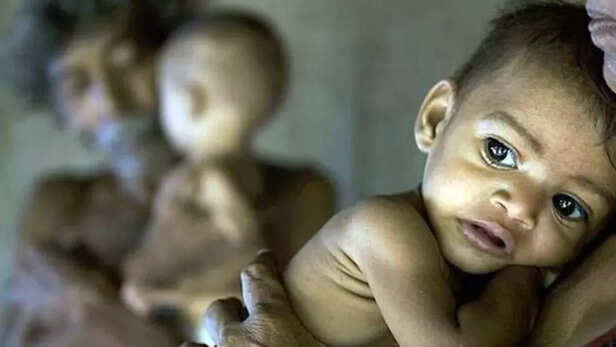 Malnutrition: ओडिशा के 12 जिलों में कुपोषण दर राष्ट्रीय से अधिक, सबसे अधिक  कुपोषित बच्चे मालकानगिरी में - Malnutrition rate in Odisha higher than  national rate