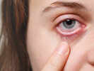 7 Early Symptoms of Conjunctivitis You Shouldn’t Ignore