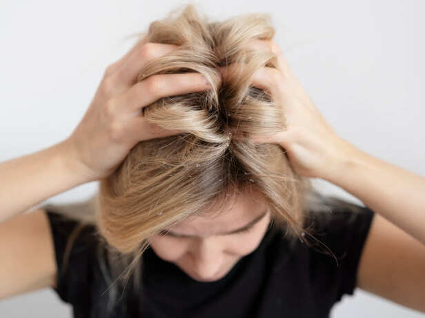 Dry Scalp and Dandruff Comparison