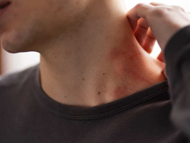 Folliculitis on skin
