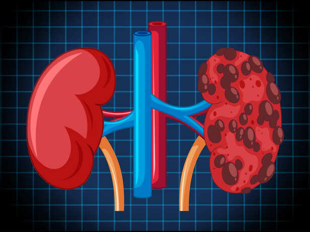 Kidney stone shown inside the urinary system