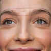 Botox Treats More Than Just Wrinkles