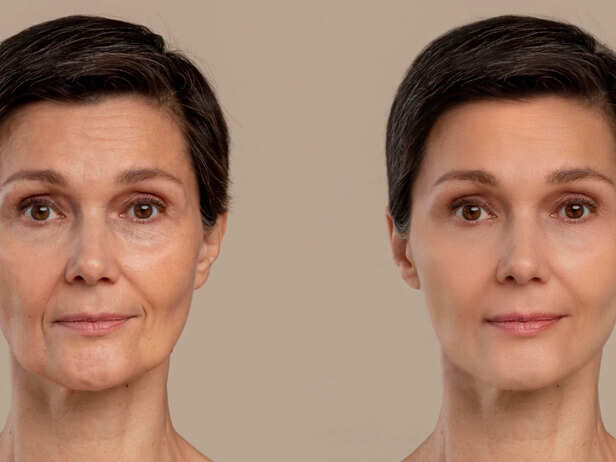 Thinner Skin Is Often Just Natural Ageing