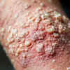Psoriasis