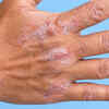 Repeated wet work