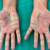 hand eczema from work