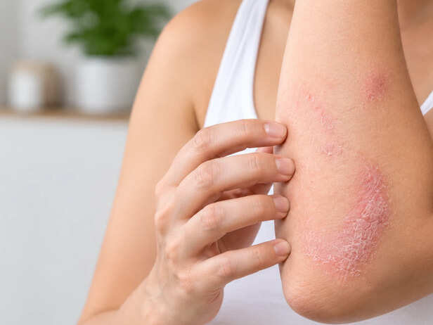 Dry patches