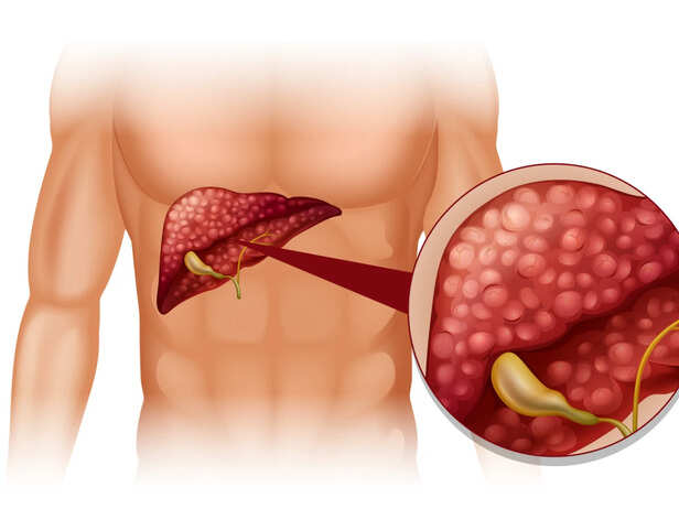 Fatty Liver