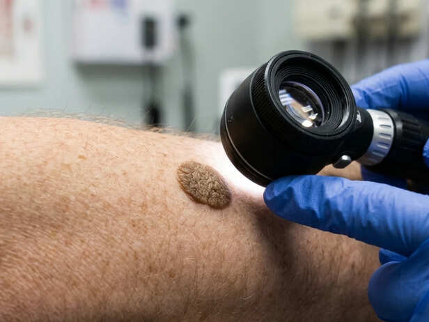 Seborrhoeic keratosis treatment